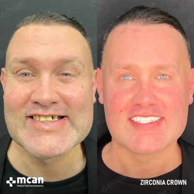 Actual MCAN Health patient: Dental Crown Result
