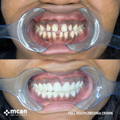 Actual MCAN Health patient: Dental Crown Result