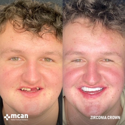 Actual MCAN Health patient: Dental Crown Result