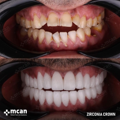 Actual MCAN Health patient: Dental Crown Result