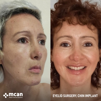 Actual MCAN Health patient: Eyelid Result