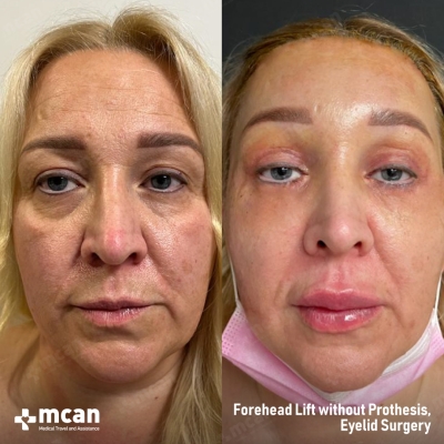 Actual MCAN Health patient: Eyelid Result