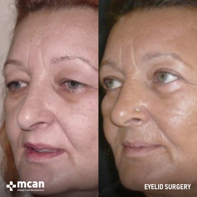 Actual MCAN Health patient: Eyelid Result