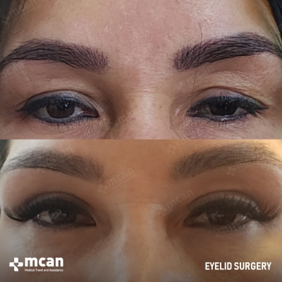 Actual MCAN Health patient: Eyelid Result