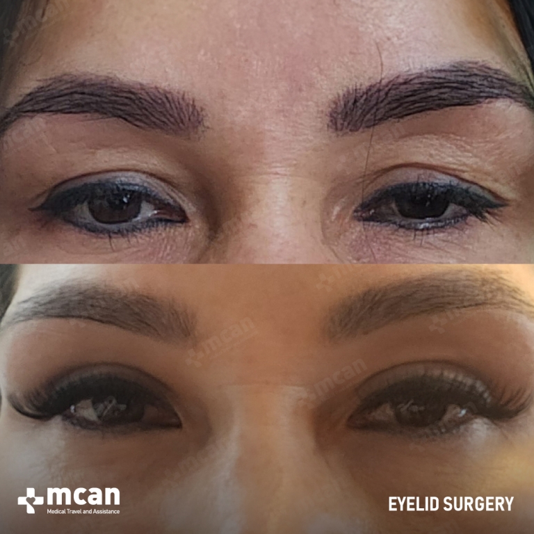 Eyelid Before & Afters 1