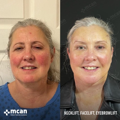 Actual MCAN Health patient: Facelift Result