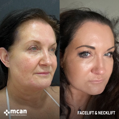 Actual MCAN Health patient: Facelift Result - Photo 2