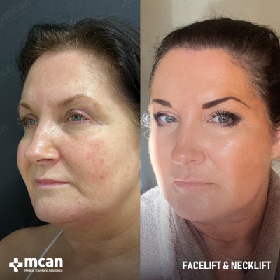 Actual MCAN Health patient: Facelift Result - Photo 3