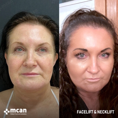Actual MCAN Health patient: Facelift Result