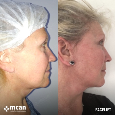 Actual MCAN Health patient: Facelift Result