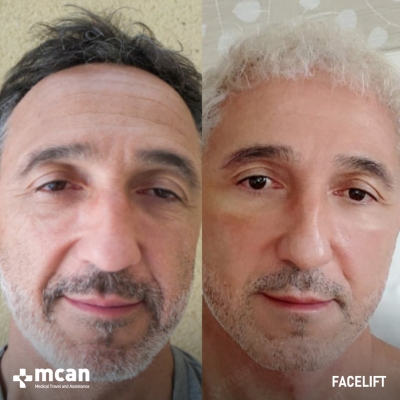Actual MCAN Health patient: Facelift Result