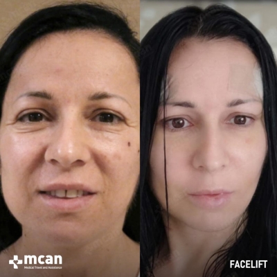 Actual MCAN Health patient: Facelift Result