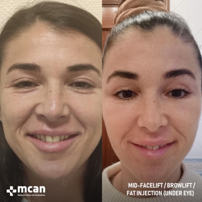Actual MCAN Health patient: Facelift Result