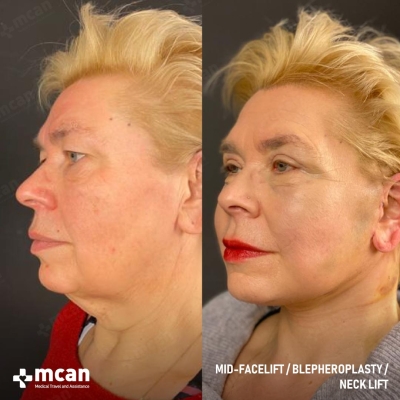Actual MCAN Health patient: Facelift Result - Photo 3