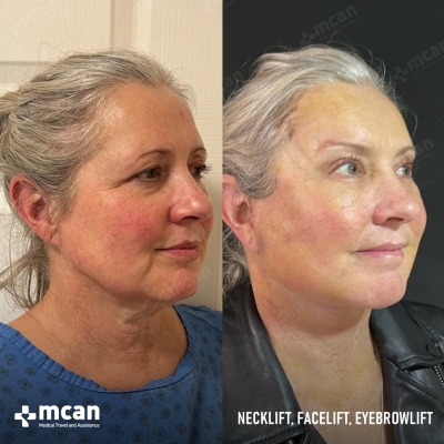 Actual MCAN Health patient: Facelift Result - Photo 2