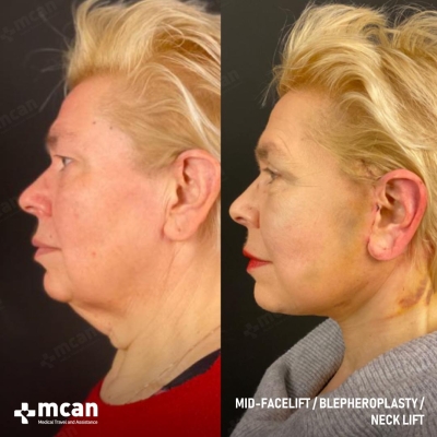 Actual MCAN Health patient: Facelift Result - Photo 2