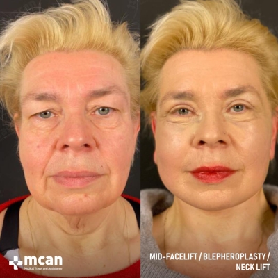 Actual MCAN Health patient: Facelift Result