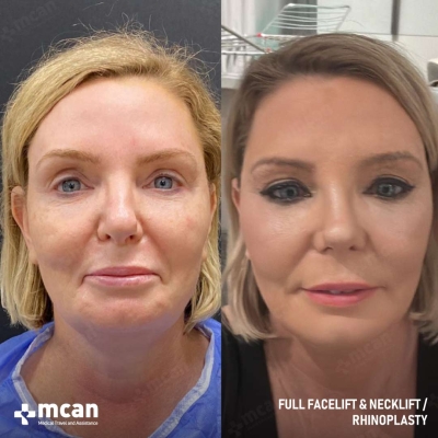 Actual MCAN Health patient: Facelift Result