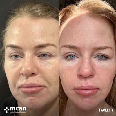 Actual MCAN Health patient: Facelift Result