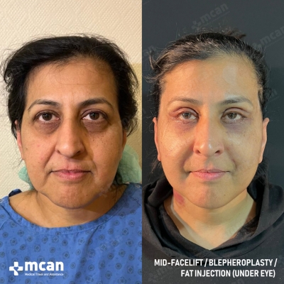 Actual MCAN Health patient: Facelift Result