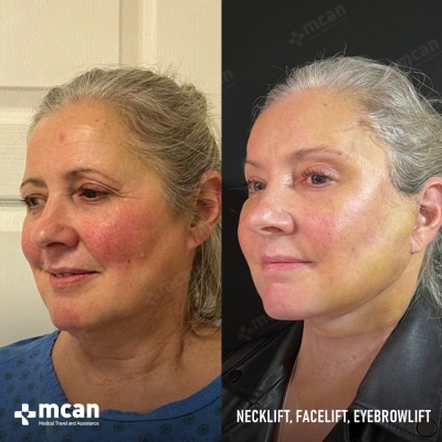 Actual MCAN Health patient: Facelift Result - Photo 3