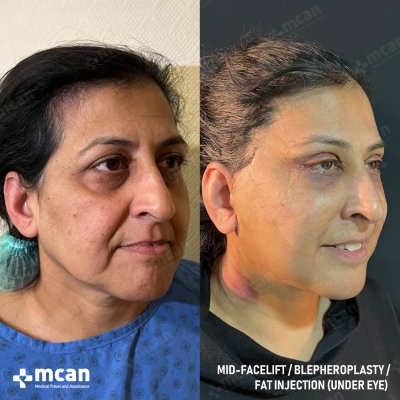 Actual MCAN Health patient: Facelift Result - Photo 2