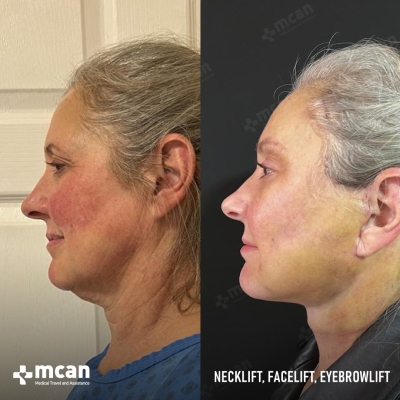 Actual MCAN Health patient: Facelift Result - Photo 4