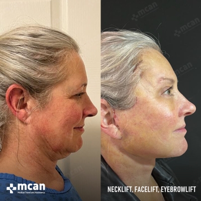 Actual MCAN Health patient: Facelift Result - Photo 5