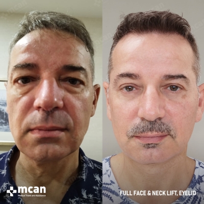 Actual MCAN Health patient: Facelift Result