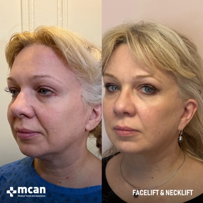 Actual MCAN Health patient: Facelift Result