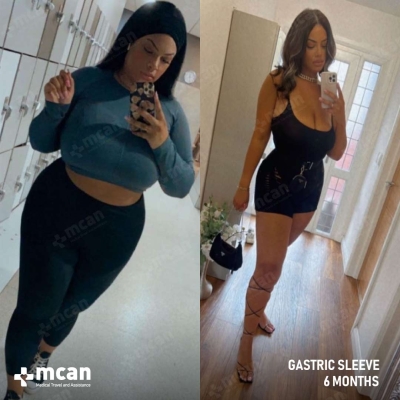 Actual MCAN Health patient: Gastric Sleeve Result