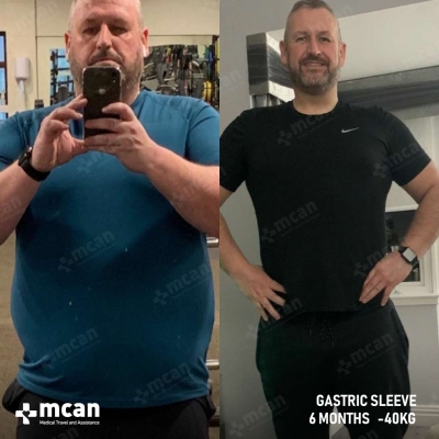 Actual MCAN Health patient: Gastric Sleeve Result