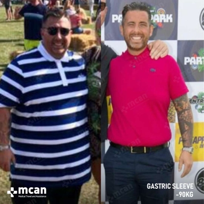Actual MCAN Health patient: Gastric Sleeve Result