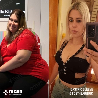 Actual MCAN Health patient: Gastric Sleeve Result