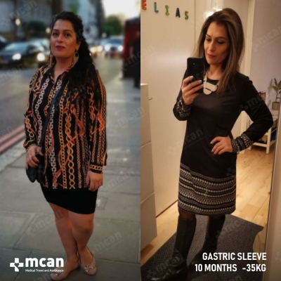 Actual MCAN Health patient: Gastric Sleeve Result