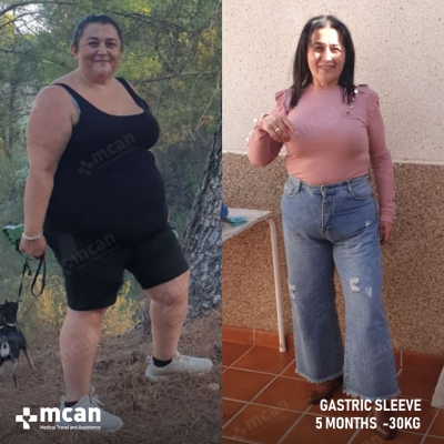 Actual MCAN Health patient: Gastric Sleeve Result