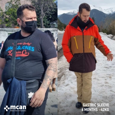 Actual MCAN Health patient: Gastric Sleeve Result