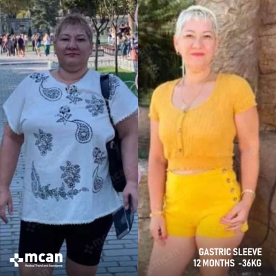 Actual MCAN Health patient: Gastric Sleeve Result