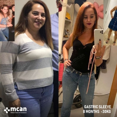 Actual MCAN Health patient: Gastric Sleeve Result