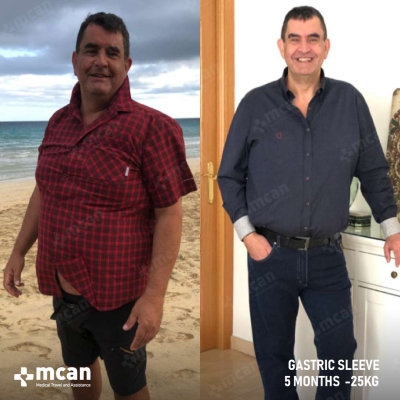 Actual MCAN Health patient: Gastric Sleeve Result