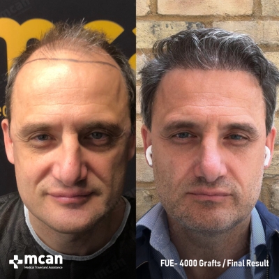 Actual MCAN Health patient: 4000 Grafts FUE Hair Transplant — Final Result
