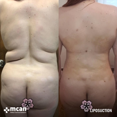 Actual MCAN Health patient: Liposuction Result