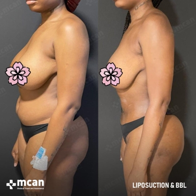 Actual MCAN Health patient: Liposuction Result