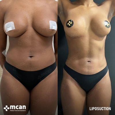 Actual MCAN Health patient: Liposuction Result