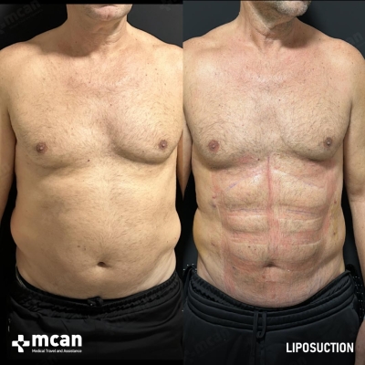 Actual MCAN Health patient: Liposuction Result