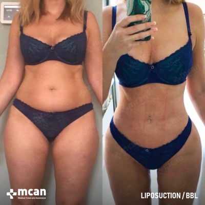 Actual MCAN Health patient: Liposuction Result
