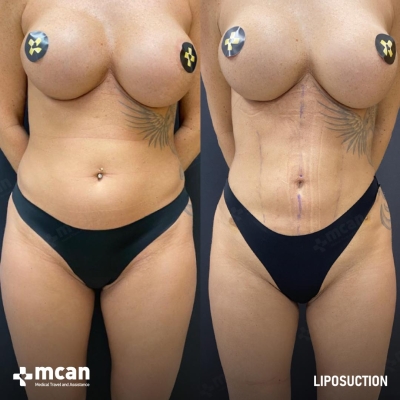 Actual MCAN Health patient: Liposuction Result