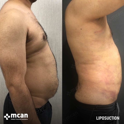 Actual MCAN Health patient: Liposuction Result
