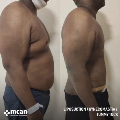 Actual MCAN Health patient: Liposuction Result