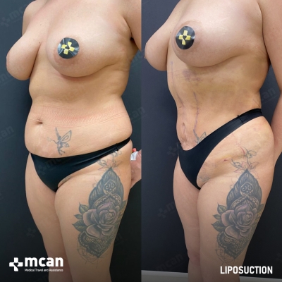 Actual MCAN Health patient: Liposuction Result - Photo 3